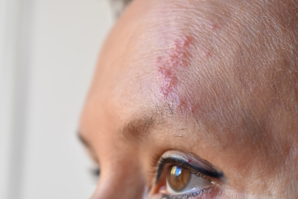 Gürtelrose: Steigende Zahlen, teure Impfung